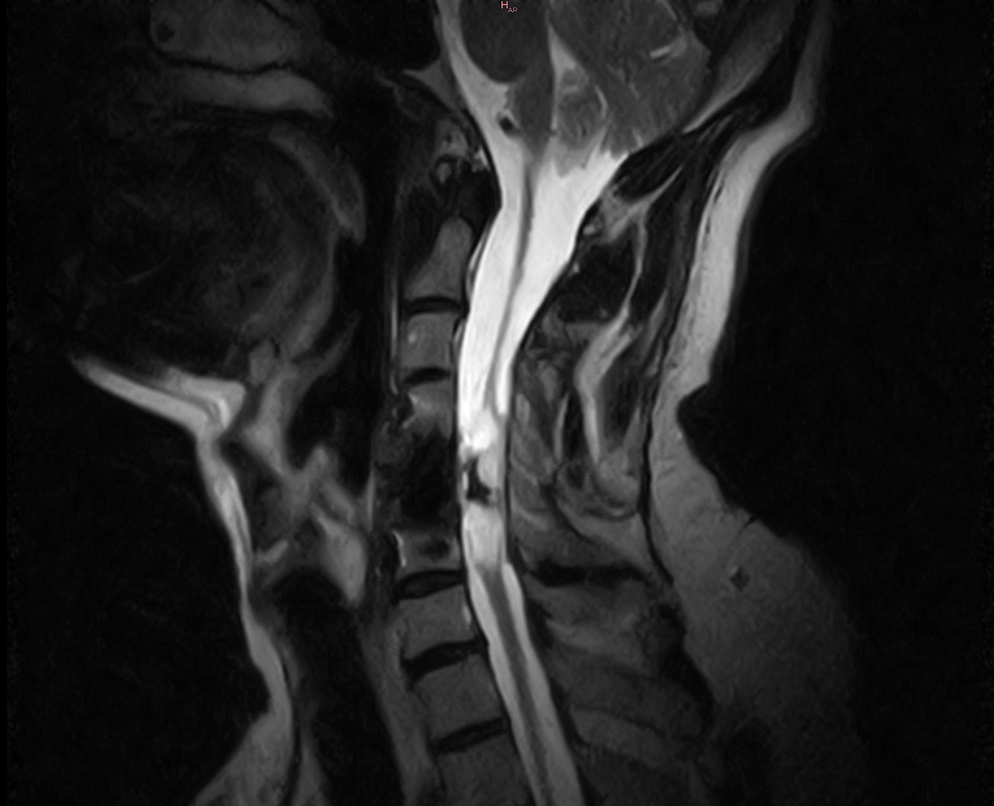 MRI of Mike's cervical spinal cord injury at C3-C4-C5